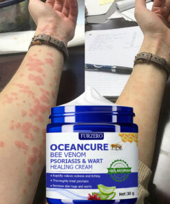 Furzero™ OceanCure Bee Venom Psoriasis & Wart Healing Cream