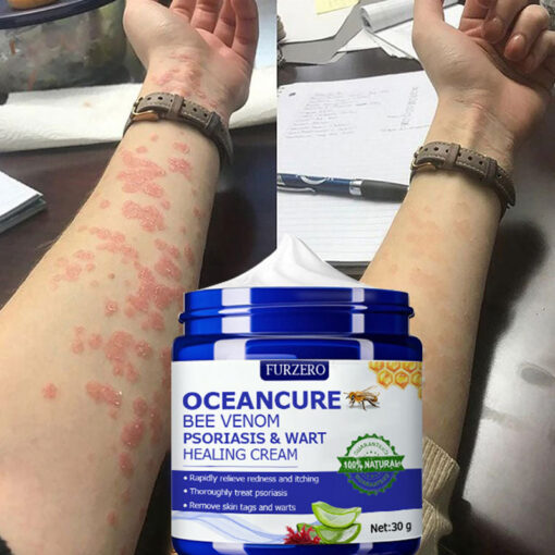 Furzero™ OceanCure Bee Venom Psoriasis & Wart Healing Cream