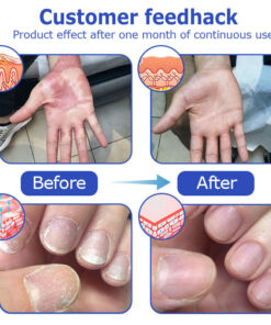 Furzero™ OceanCure Bee Venom Psoriasis & Wart Healing Cream