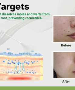 AEXZR™ Herbal Moles & Warts Removal Spray