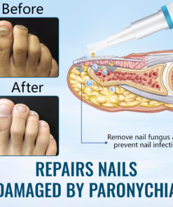 Ceoerty™ Anti-Paronychia Nail Repairing Gel