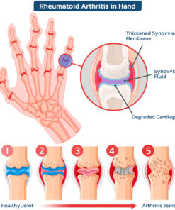 FLYCARE™ Bee Venom Advanced Joint and Bone Therapy Cream