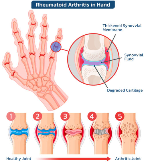 FLYCARE™ Bee Venom Advanced Joint and Bone Therapy Cream