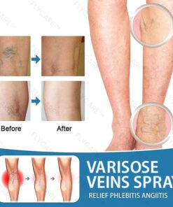 FLYCARE™ Varicose Veins Spray