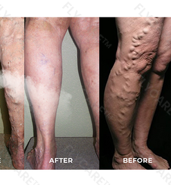 FLYCARE™ Varicose Veins Spray