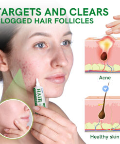 Furzero™ Follicle Acne Purify Cream