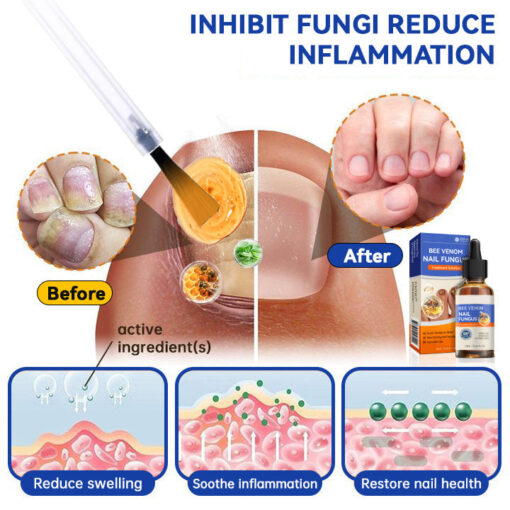 Lotmay® Bee Venom Nail Fungus Treatment Solution