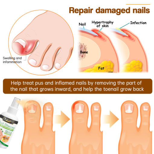 Ourlyard™ Bee Venom Nail Disease Treatment Spray