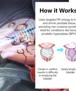 Oveallgo™ ProstateFlow RF Therapy Band