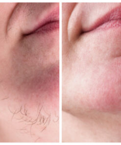 PCOS Facial Hair Natural Treatment At Home