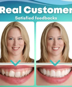 EzySmile™ SnapOn Silicone Veneers