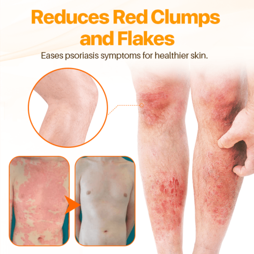 FLYCARE™ Psoriasis Anti-Bacterial Cream