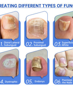 Furzero™ Advanced PureNail Fungus Laser Device