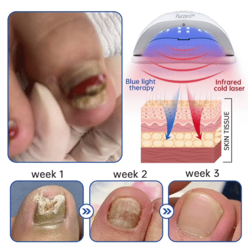 Furzero™ Advanced PureNail Fungus Laser Device