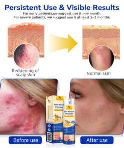 LOVILDS™ PsoriaHeal Bee Venom Psoriasis Treatment Spray