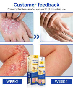 LOVILDS™ PsoriaHeal Bee Venom Psoriasis Treatment Spray