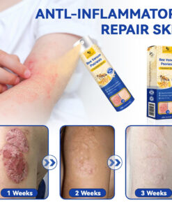 LOVILDS™ PsoriaHeal Bee Venom Psoriasis Treatment Spray