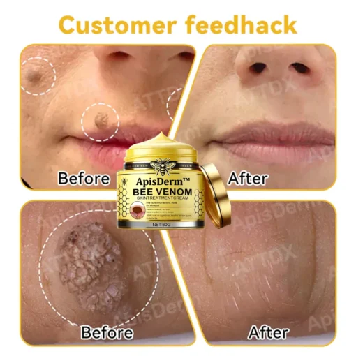 ApisDerm™ Bee Venom Skin Treatment Cream