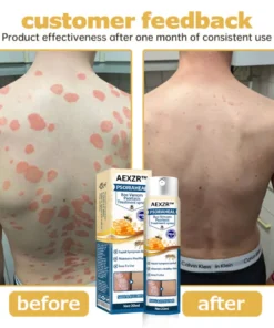 AEXZR™ PsoriaHeal Bee Venom Psoriasis Treatment Spray