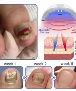 Furzero™ PureNail Fungus Laser Device