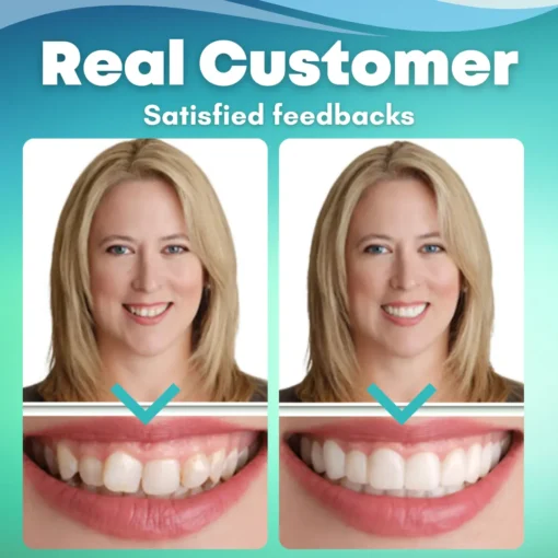 EzySmile™ SnapOn Silicone Veneers - Image 5